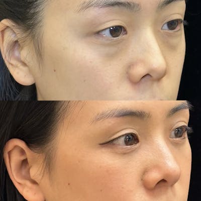 Lower Blepharoplasty Before & After Gallery - Patient 128035 - Image 3