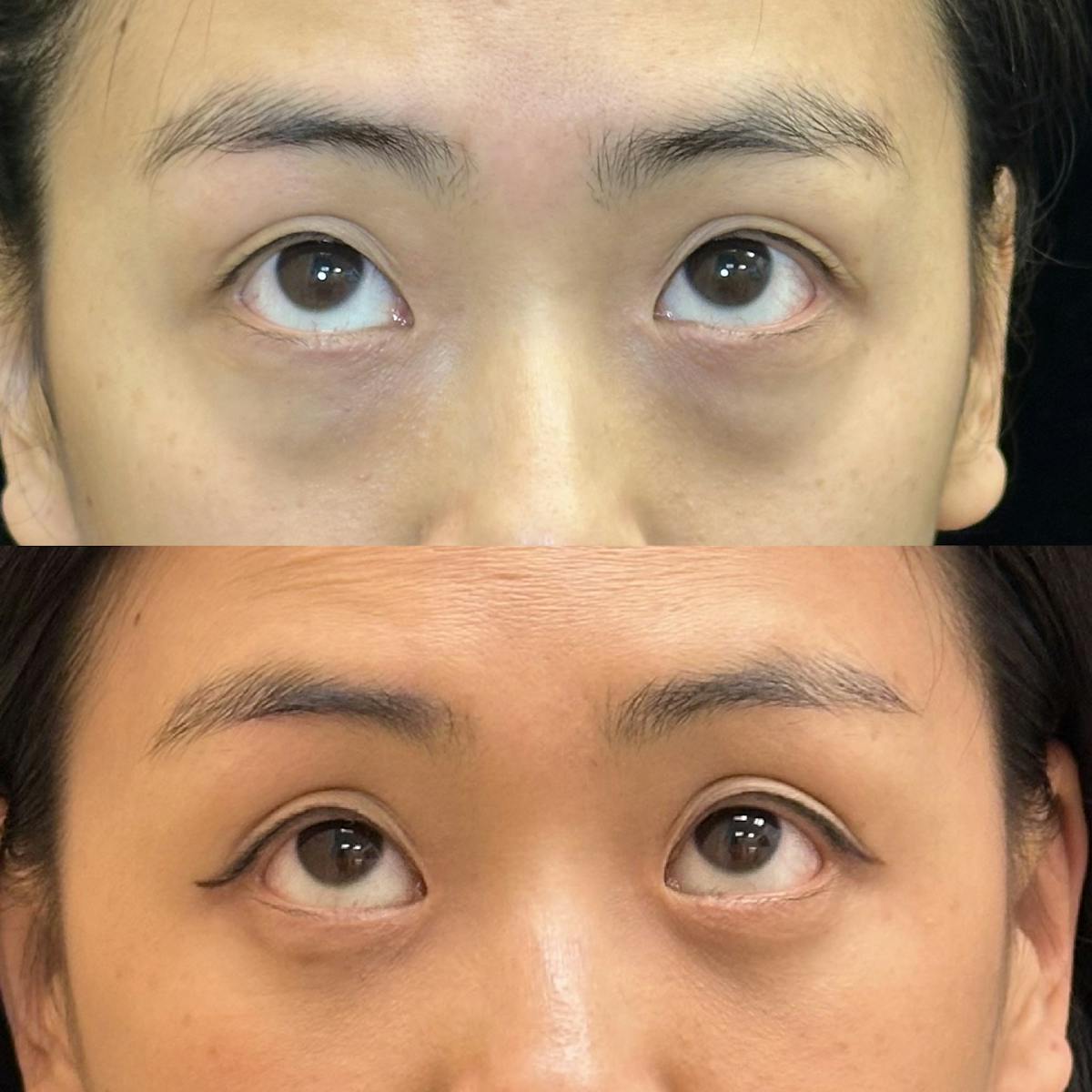 Lower Blepharoplasty Before & After Gallery - Patient 128035 - Image 2