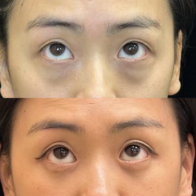 Lower Blepharoplasty Before & After Gallery - Patient 128035 - Image 2