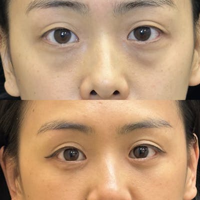Lower Blepharoplasty Before & After Gallery - Patient 128035 - Image 1