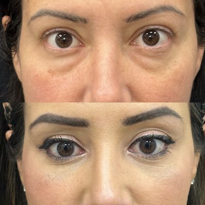 Lower Blepharoplasty Before & After Gallery - Patient 295392 - Image 3