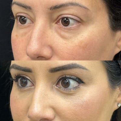 Lower Blepharoplasty Before & After Gallery - Patient 295392 - Image 1