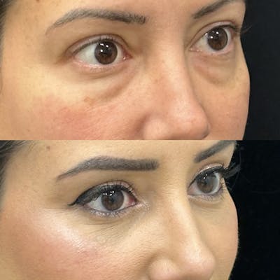 Lower Blepharoplasty Before & After Gallery - Patient 295392 - Image 2