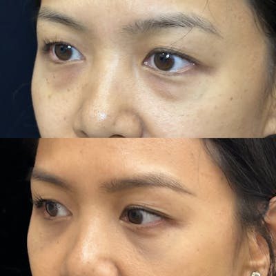 Lower Blepharoplasty Before & After Gallery - Patient 376568 - Image 3