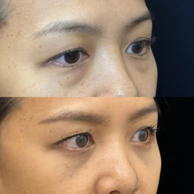 Lower Blepharoplasty Before & After Gallery - Patient 376568 - Image 2