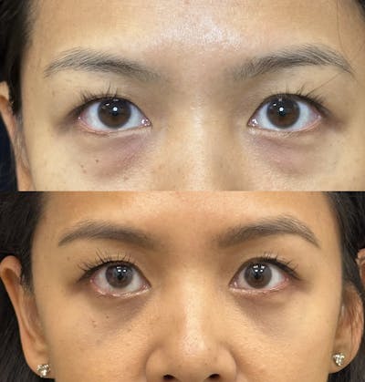 Lower Blepharoplasty Before & After Gallery - Patient 376568 - Image 1
