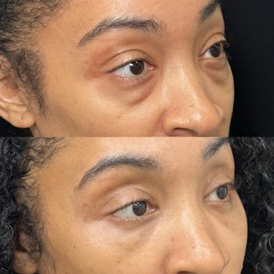 Lower Blepharoplasty Before & After Gallery - Patient 270809 - Image 2