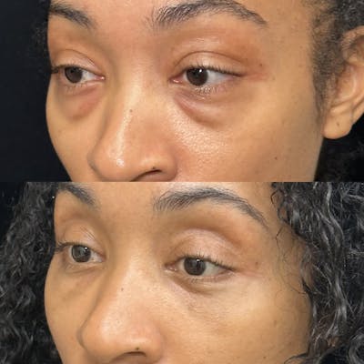 Lower Blepharoplasty Before & After Gallery - Patient 270809 - Image 3