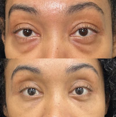 Lower Blepharoplasty Before & After Gallery - Patient 270809 - Image 1