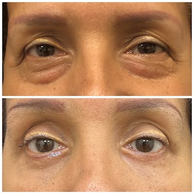 Lower Blepharoplasty Before & After Gallery - Patient 109175 - Image 1