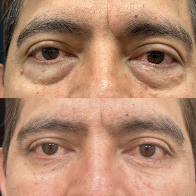 Lower Blepharoplasty Before & After Gallery - Patient 357516 - Image 1