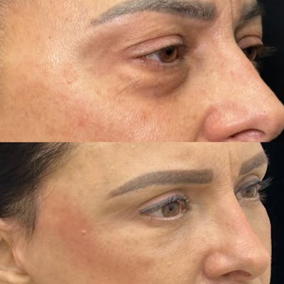Lower Blepharoplasty Before & After Gallery - Patient 208816 - Image 2