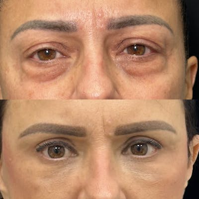 Lower Blepharoplasty Before & After Gallery - Patient 208816 - Image 1