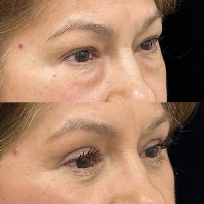 Lower Blepharoplasty Before & After Gallery - Patient 311899 - Image 2
