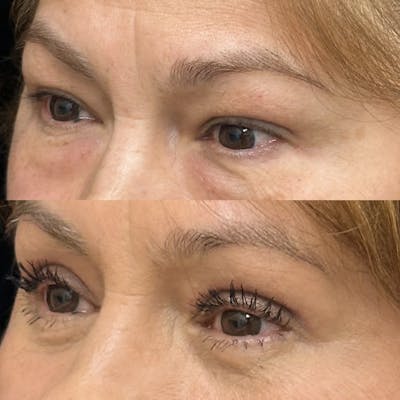 Lower Blepharoplasty Before & After Gallery - Patient 311899 - Image 3