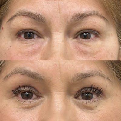 Upper Blepharoplasty Before & After Gallery - Patient 284939 - Image 1