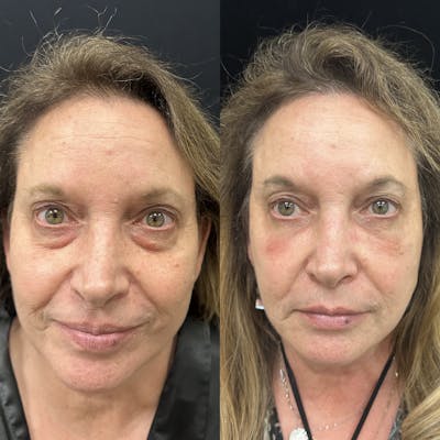 Lower Blepharoplasty Before & After Gallery - Patient 130225 - Image 1