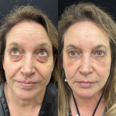 Lower Blepharoplasty Before & After Gallery - Patient 130225 - Image 2