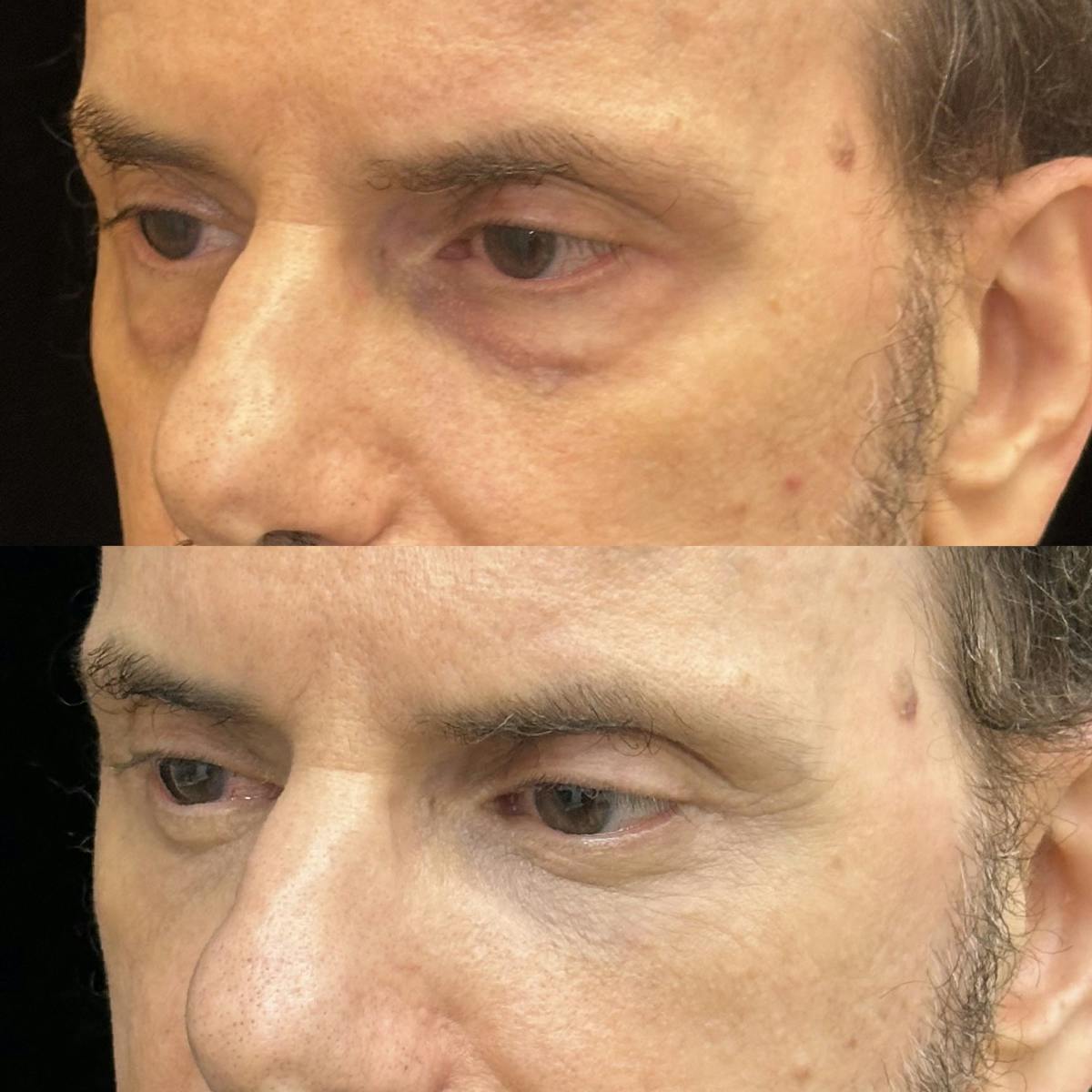 Lower Blepharoplasty Before & After Gallery - Patient 125092 - Image 3