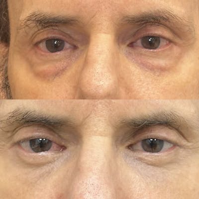 Lower Blepharoplasty Before & After Gallery - Patient 125092 - Image 1