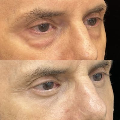 Lower Blepharoplasty Before & After Gallery - Patient 125092 - Image 2