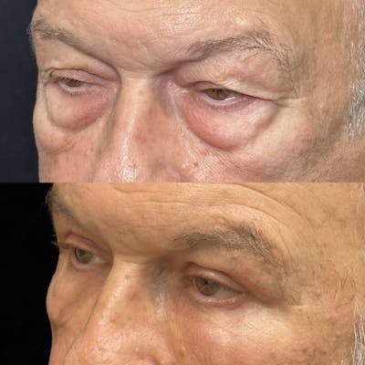 Lower Blepharoplasty Before & After Gallery - Patient 318425 - Image 3