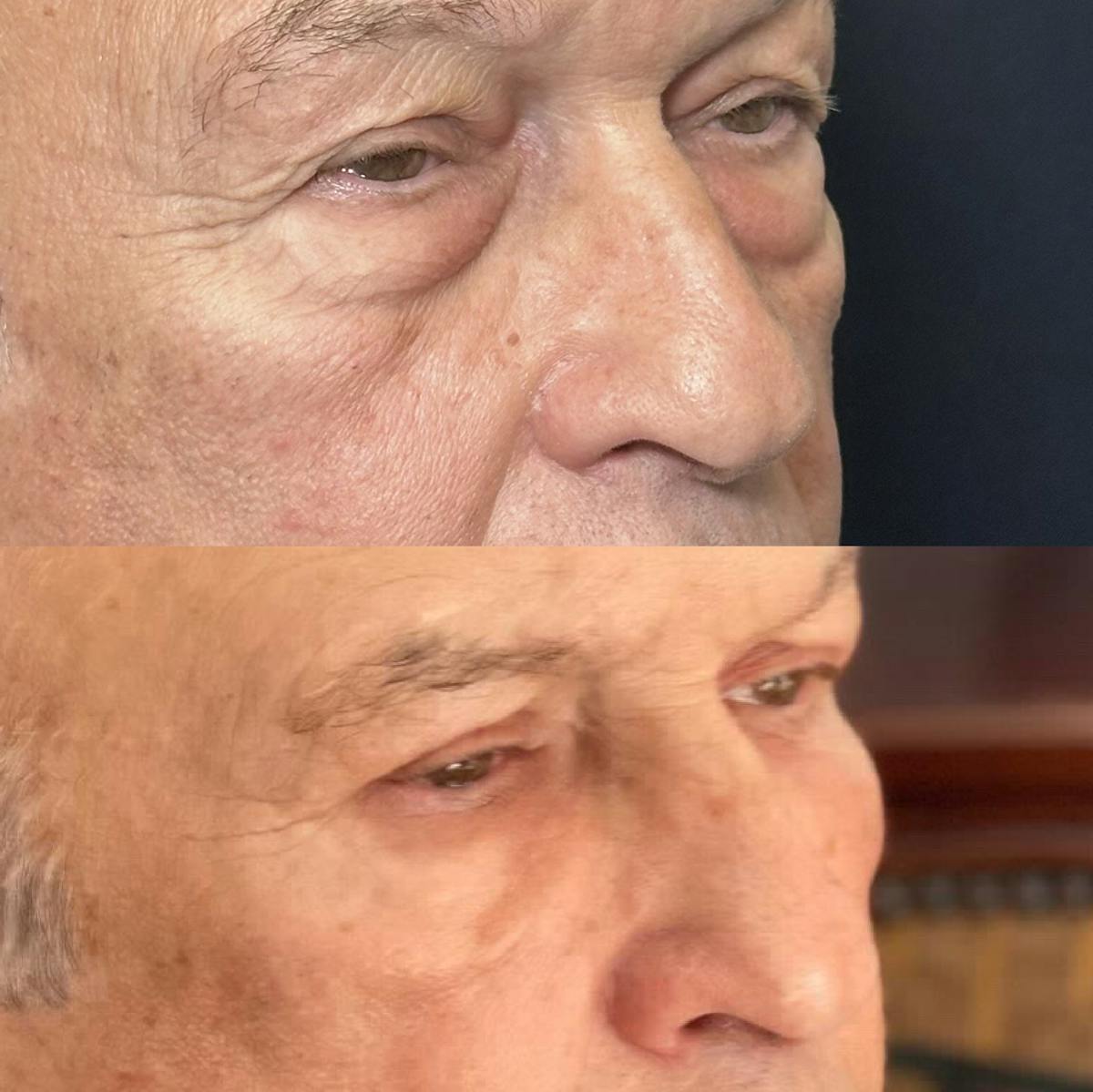 Lower Blepharoplasty Before & After Gallery - Patient 318425 - Image 2