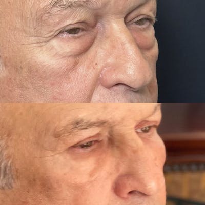 Lower Blepharoplasty Before & After Gallery - Patient 318425 - Image 2
