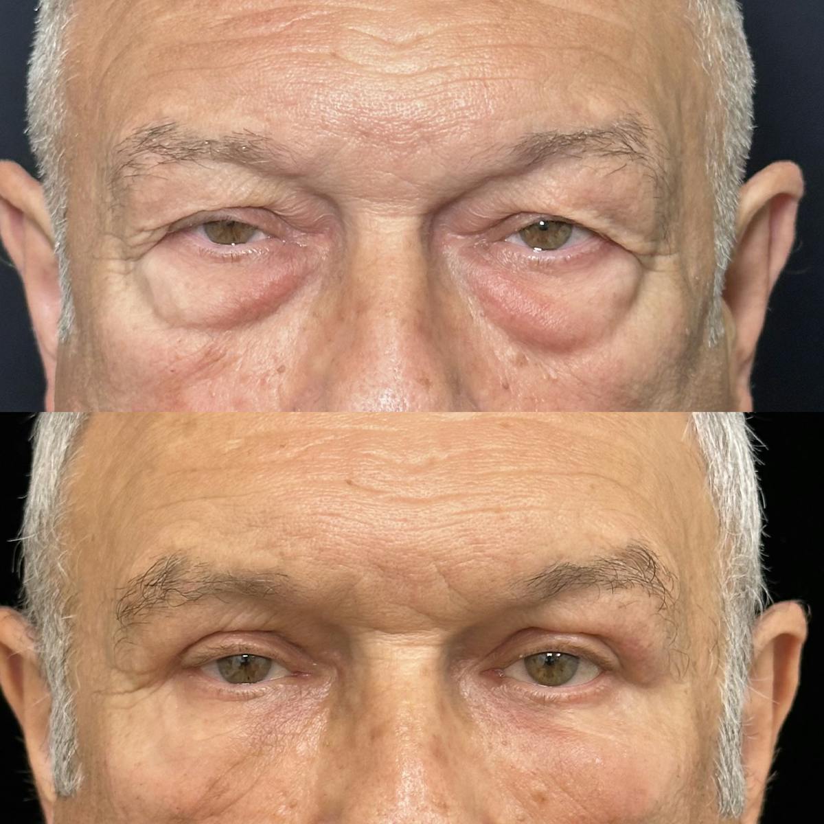 Lower Blepharoplasty Before & After Gallery - Patient 318425 - Image 1