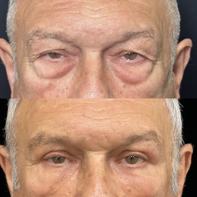 Lower Blepharoplasty Before & After Gallery - Patient 318425 - Image 1