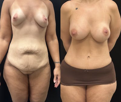 Mommy Makeover Before & After Gallery - Patient 942528 - Image 1