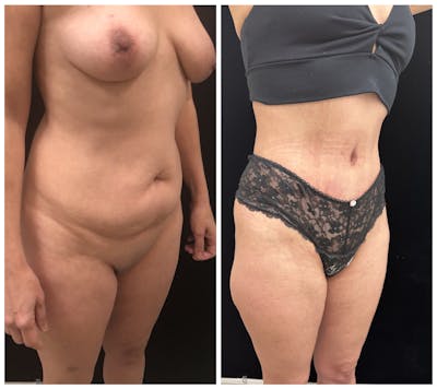 Mommy Makeover Before & After Gallery - Patient 187381 - Image 2