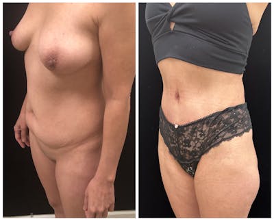 Mommy Makeover Before & After Gallery - Patient 187381 - Image 3