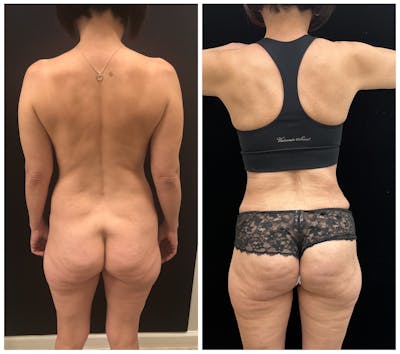 Mommy Makeover Before & After Gallery - Patient 187381 - Image 4