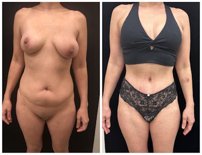 Mommy Makeover Before & After Gallery - Patient 187381 - Image 1