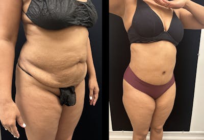 Mommy Makeover Before & After Gallery - Patient 403295 - Image 2