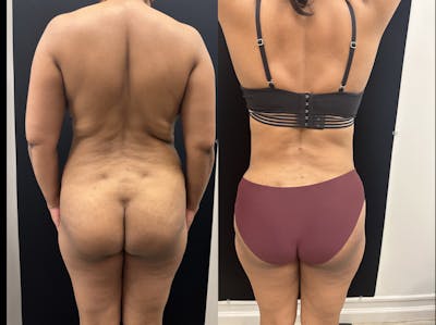 Mommy Makeover Before & After Gallery - Patient 403295 - Image 4