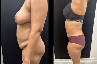 Mommy Makeover Before & After Gallery - Patient 403295 - Image 3