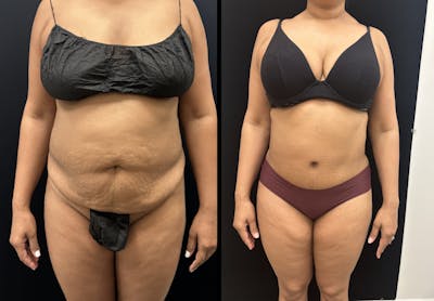 Mommy Makeover Before & After Gallery - Patient 403295 - Image 1