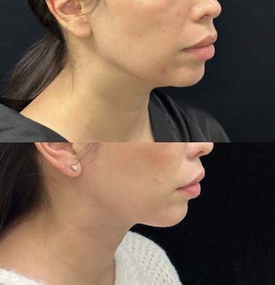 Necklift Before & After Gallery - Patient 262741 - Image 1