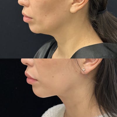 Necklift Before & After Gallery - Patient 262741 - Image 3