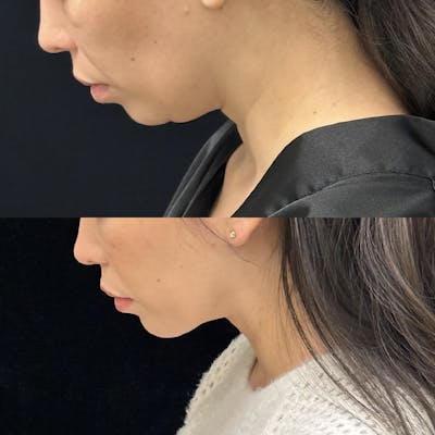 Necklift Before & After Gallery - Patient 262741 - Image 4