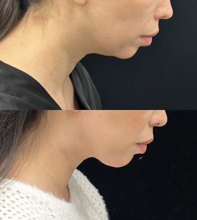Necklift Before & After Gallery - Patient 262741 - Image 2