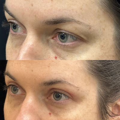 Upper Blepharoplasty Before & After Gallery - Patient 365252 - Image 3
