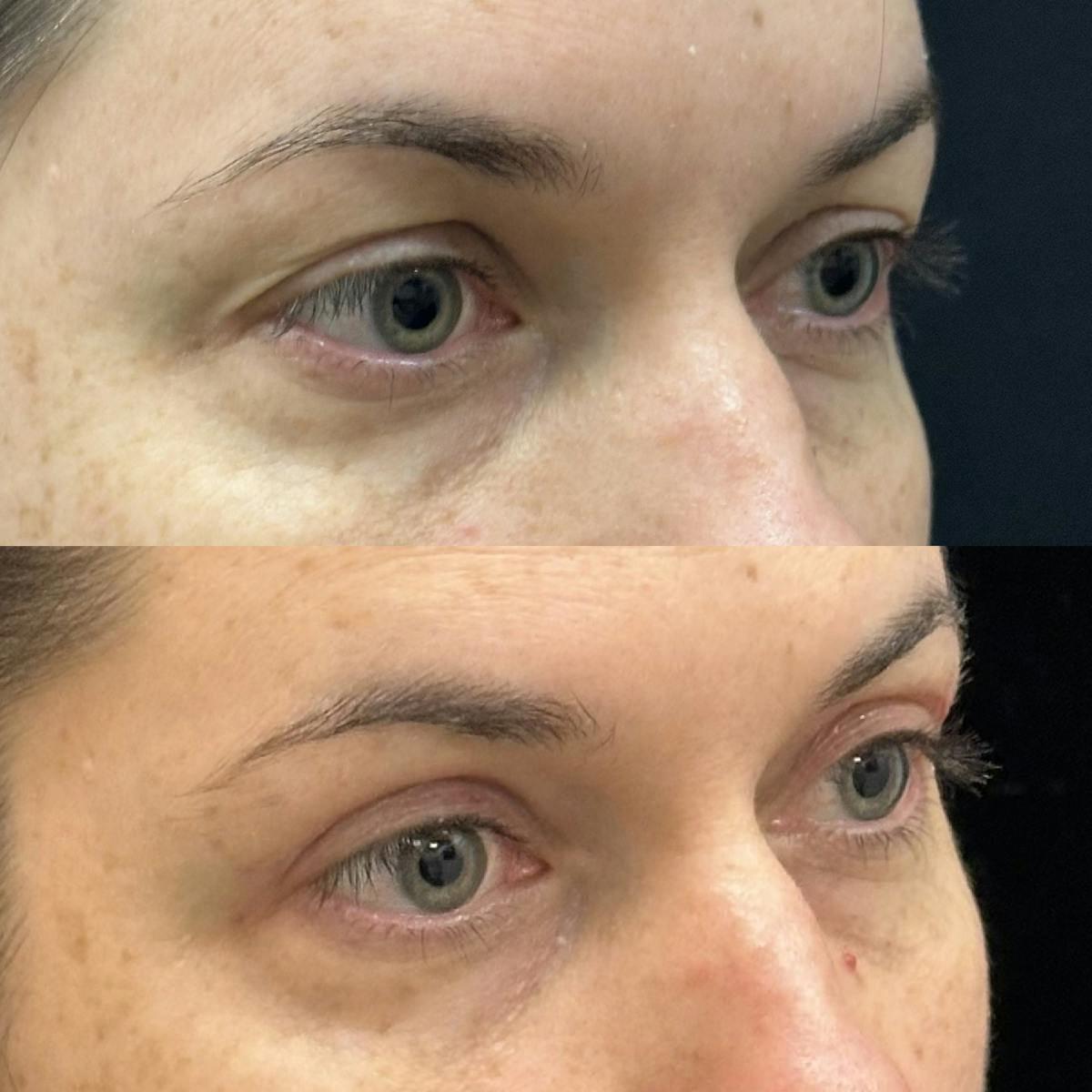  Upper Blepharoplasty Before & After Gallery - Patient 365252 - Image 2