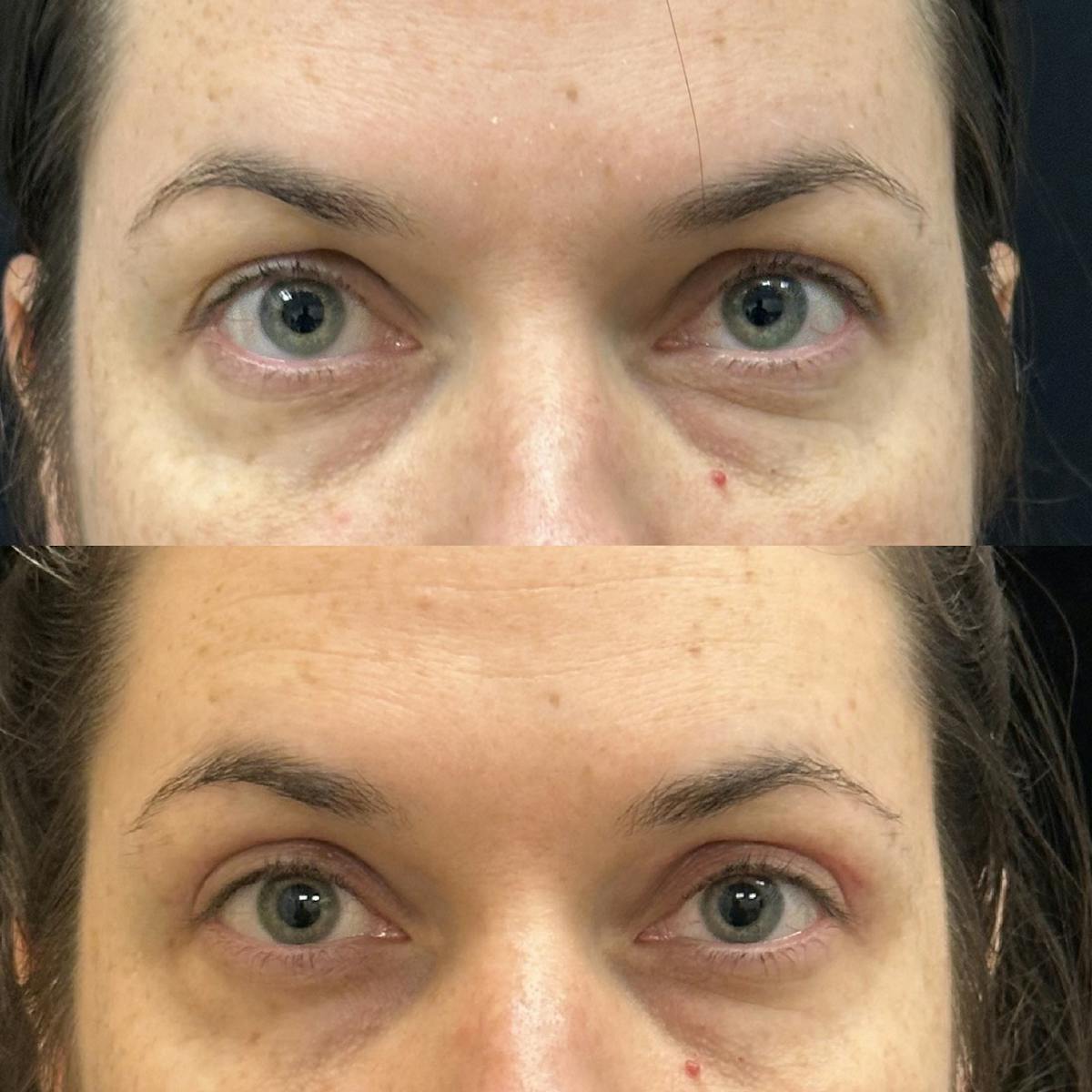  Upper Blepharoplasty Before & After Gallery - Patient 365252 - Image 1
