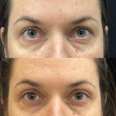 Upper Blepharoplasty Before & After Gallery - Patient 365252 - Image 1