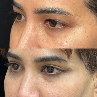 Upper Blepharoplasty Before & After Gallery - Patient 574758 - Image 3