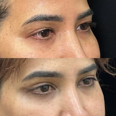 Upper Blepharoplasty Before & After Gallery - Patient 574758 - Image 2