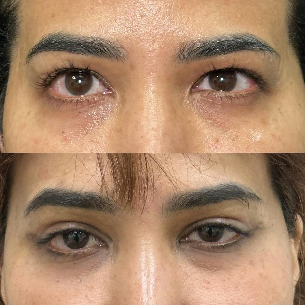  Upper Blepharoplasty Before & After Gallery - Patient 574758 - Image 1